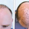 ... Du vil nok gerne undgå hårtransplantationer. - Dårligt nyt til man-bun folket: Hipster-halen kan gøre dig skaldet