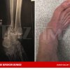 Steve-O brækkede knogler i begge ben efter uheldigt stunt