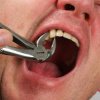 Mænd forsøger at rive tand ud med hjælp fra cykel, bil og tang [Video]