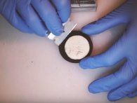 Peanut-butter-ectomi med Oreo creme transplantation