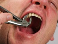 Mænd forsøger at rive tand ud med hjælp fra cykel, bil og tang [Video]